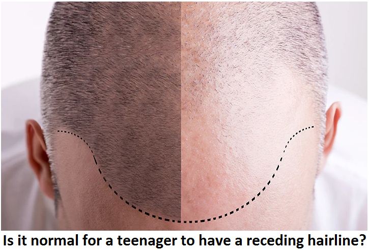 is it normal for a teenager to have a receding hairline