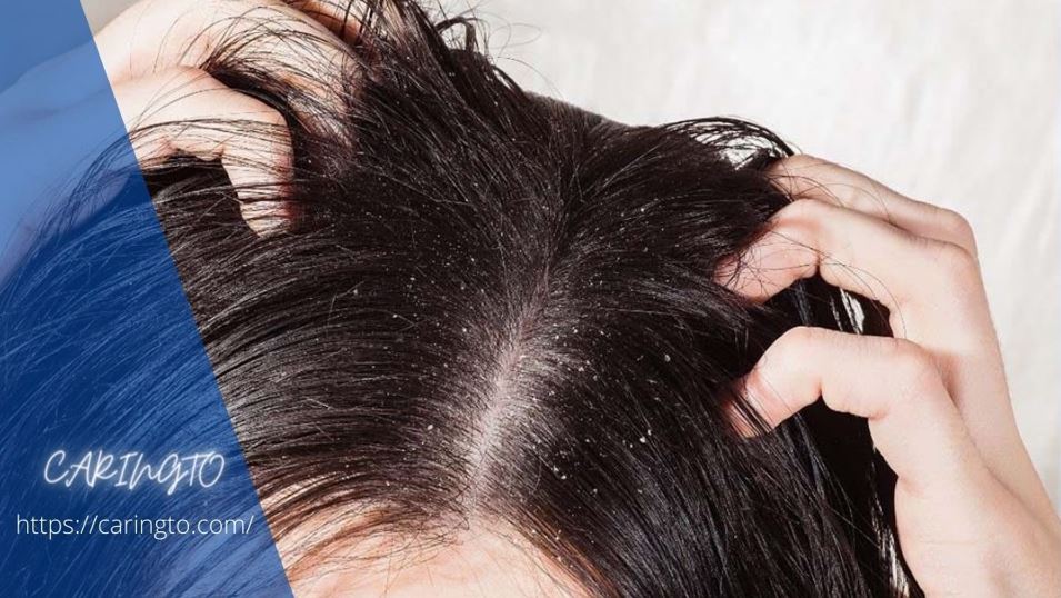 How to get rid of dandruff