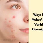 Ways To Make A Zit Vanish Overnight