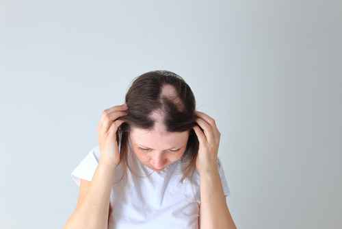 alopecia causes in females