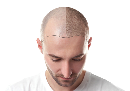 mature hairlline and receding hairline