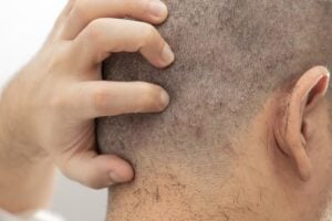 causes of scalp pain