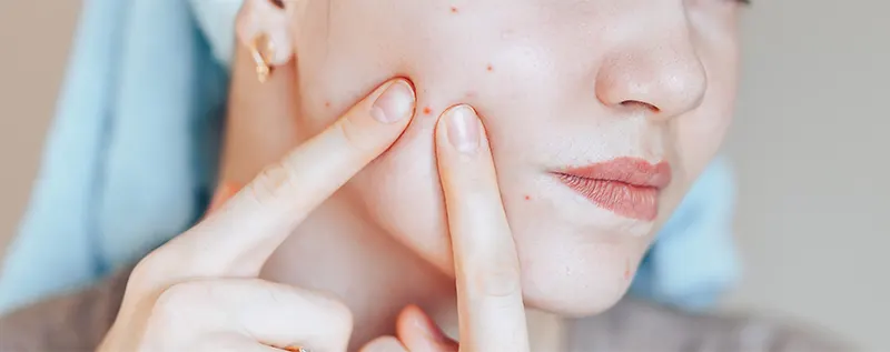 Pimples on face