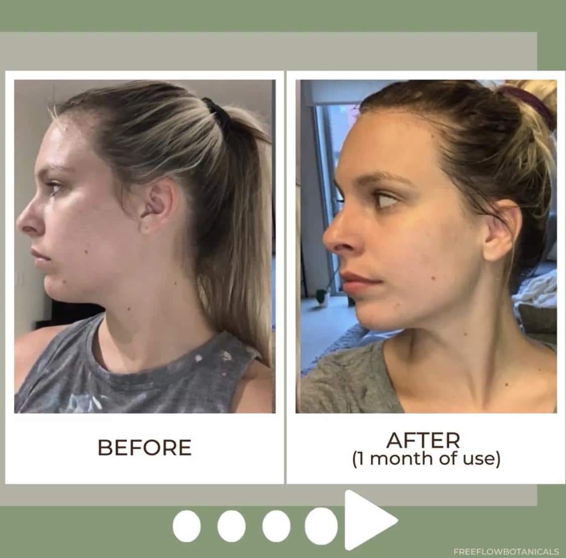 Effects of Gua Sha for jawline Before and After  