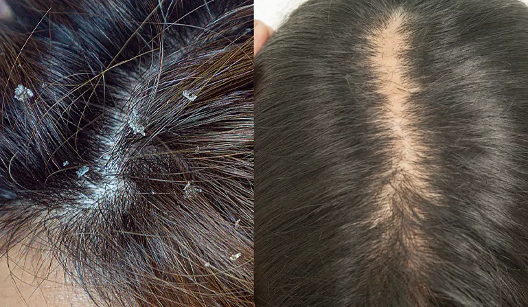Scalp problems with hair dye