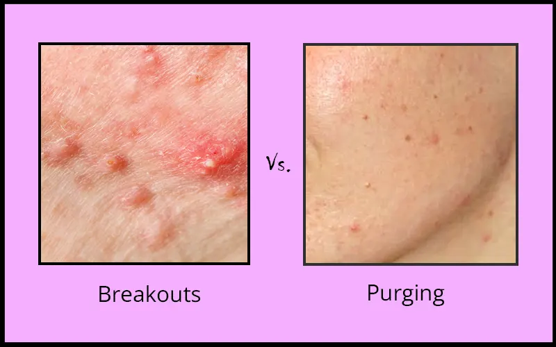 Purging Vs Breakouts