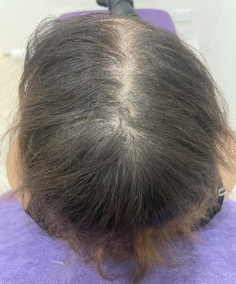 Why Does My Hair Grow on One Side More Than the Other?